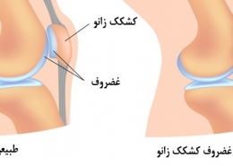 نرمی کشکک زانو