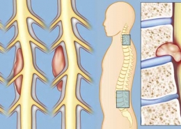 انواع تومور نخاعی