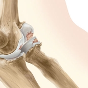 جراحی آرتروز آرنج