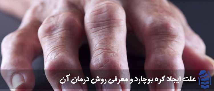 علت ایجاد گره بوچارد و معرفی روش درمان آن